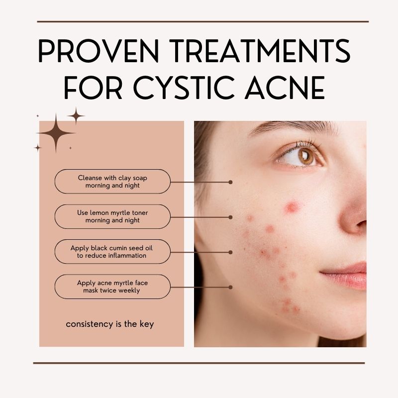 5 Proven Natural Treatments For Cystic Acne